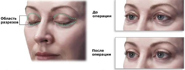 Blepharoplasty. Photos after surgery by day. Complications, recovery after circular, lower, upper. Rehabilitation, consequences