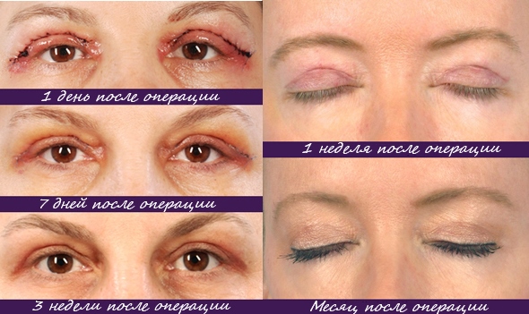 Blepharoplasty. Photos after surgery by day. Complications, recovery after circular, lower, upper. Rehabilitation, consequences