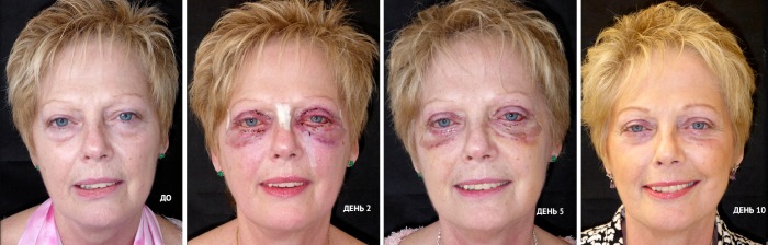 Blepharoplastik. Fotos nach der Operation bei Tag. Komplikationen, Erholung nach kreisförmigen, unteren, oberen. Rehabilitation, Folgen