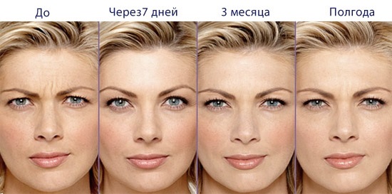 Botox injections for facial wrinkles. Before and after photos, price, consequences, contraindications of the procedure