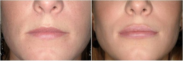 Botox injections for facial wrinkles. Before and after photos, price, consequences, contraindications of the procedure