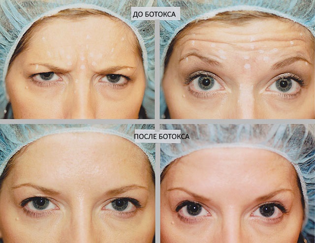 Botox injections for facial wrinkles. Before and after photos, price, consequences, contraindications of the procedure