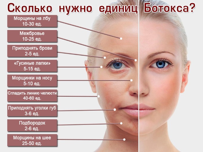 Botox injections for facial wrinkles. Before and after photos, price, consequences, contraindications of the procedure