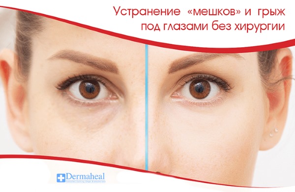 Dermahil for bags under the eyes in HSR mesotherapy. Reviews of cosmetologists