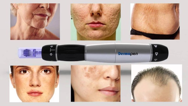 Dermapen: reviews of the procedure with a filler apparatus for fractional mesotherapy. Where to buy, how to use