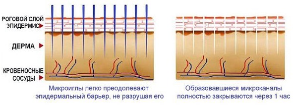 Dermapen: reviews of the procedure with a filler apparatus for fractional mesotherapy. Where to buy, how to use