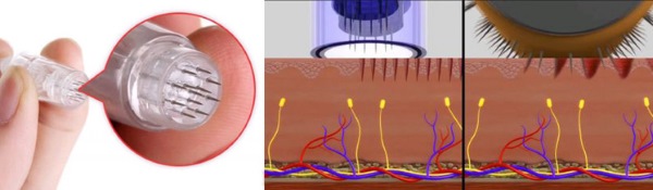 Dermapen: reviews of the procedure with a filler apparatus for fractional mesotherapy. Where to buy, how to use