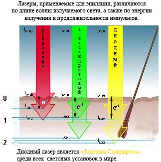 Diode laser hair removal. Apparatus for the procedure, preparation, how the laser works. Reviews, before and after photos