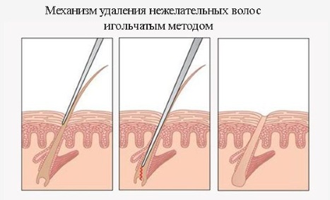 Electrolysis: reviews and effectiveness, consequences. How is it done on the face, body, bikini area, armpits