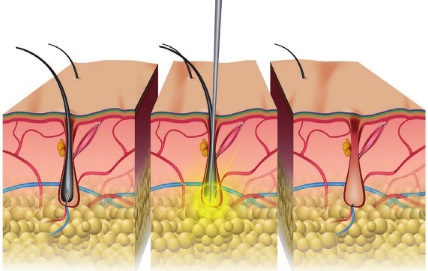 Electrolysis: reviews and effectiveness, consequences. How is it done on the face, body, bikini area, armpits