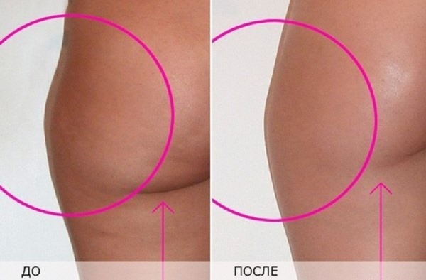 Come sbarazzarsi della cellulite sulle gambe a casa: rapidamente, dopo il parto, dietro, sui polpacci. Esercizio, impacchi, massaggi, dieta