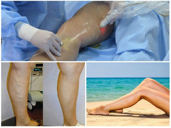 Laser removal of leg veins with varicose veins. How is the operation going, the postoperative period, rehabilitation, consequences, complications