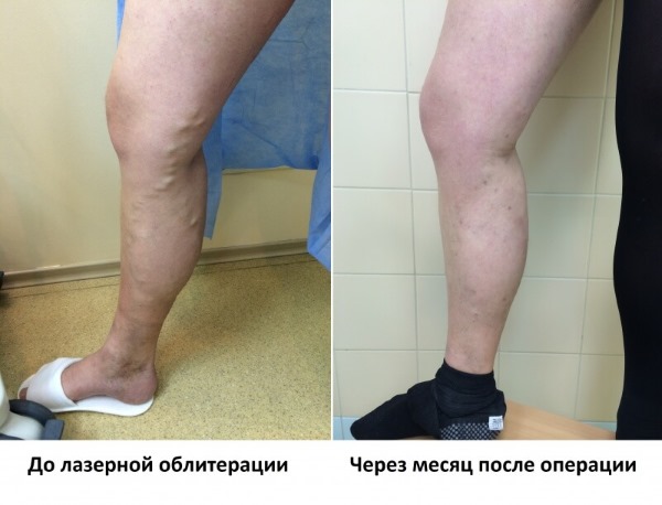 Laser removal of leg veins with varicose veins. How is the operation going, the postoperative period, rehabilitation, consequences, complications