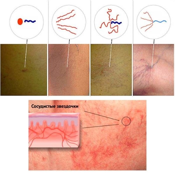 Laser removal of leg veins with varicose veins. How is the operation going, the postoperative period, rehabilitation, consequences, complications