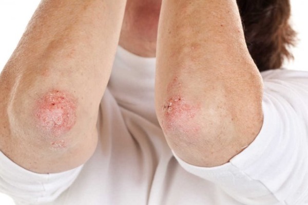 Elbows rough and dark. Causes, signs of the disease, skin treatment in adults and children