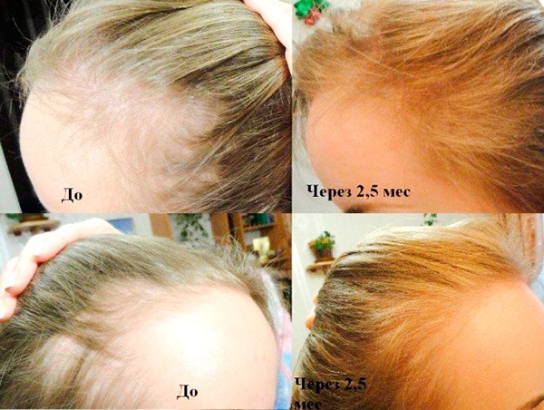 The best remedies for hair loss for women during pregnancy, lactation, after childbirth, coloring, chemotherapy, hormonal imbalance