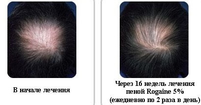 The best remedies for hair loss for women during pregnancy, lactation, after childbirth, coloring, chemotherapy, hormonal imbalance