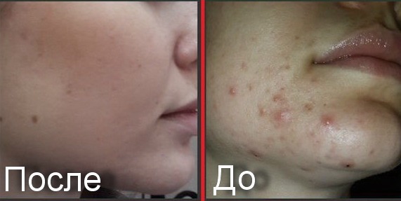 Metrogyl acne gel. Reviews of doctors and buyers, composition, effectiveness, instructions for use