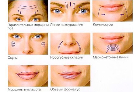 Mesovarton for face biorevitalization. Composition of the drug, manufacturer, consequences, reviews of cosmetologists and price