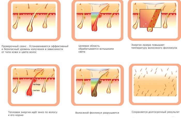 Diode laser hair removal. Apparatus for the procedure, preparation, how the laser works. Reviews, before and after photos