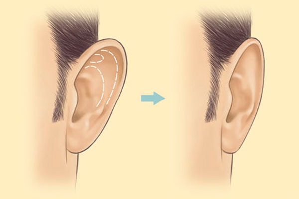 Chirurgia plastica facciale. Foto prima e dopo il contouring con acido ialuronico. Prezzi, recensioni