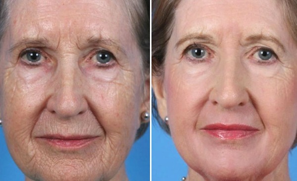 Facial plastic surgery. Photos before and after contouring surgery with hyaluronic acid. Prices, reviews