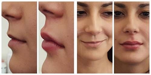 Chirurgia plastica facciale. Foto prima e dopo il contouring con acido ialuronico. Prezzi, recensioni