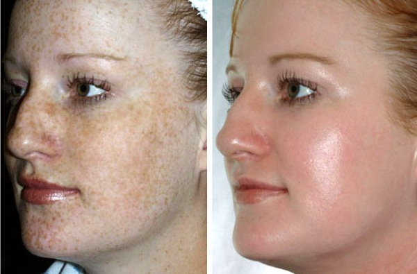 Facial plastic surgery. Photos before and after contouring surgery with hyaluronic acid. Prices, reviews