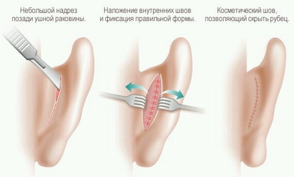 Facial plastic surgery. Photos before and after contouring surgery with hyaluronic acid. Prices, reviews