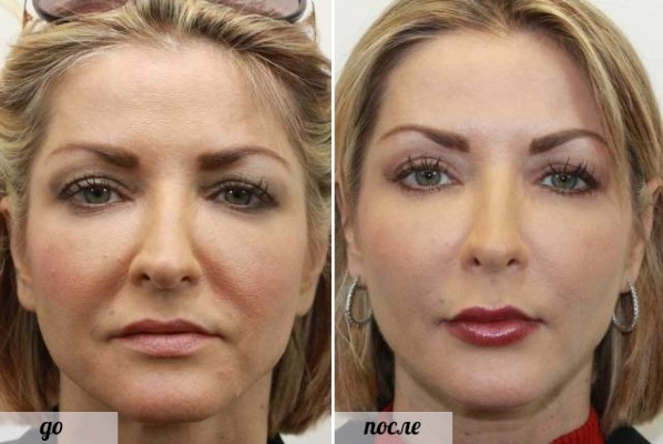 Facial plastic surgery. Photos before and after contouring surgery with hyaluronic acid. Prices, reviews