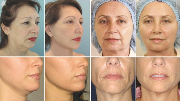 Facial plastic surgery. Photos before and after contouring surgery with hyaluronic acid. Prices, reviews