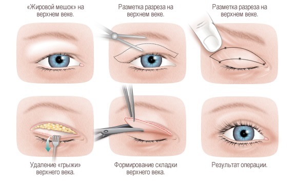 Facial plastic surgery. Photos before and after contouring surgery with hyaluronic acid. Prices, reviews