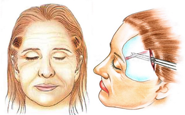 Chirurgia plastica facciale. Foto prima e dopo il contouring con acido ialuronico. Prezzi, recensioni