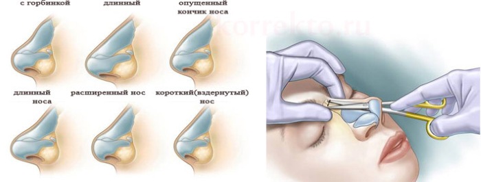 Facial plastic surgery. Photos before and after contouring surgery with hyaluronic acid. Prices, reviews