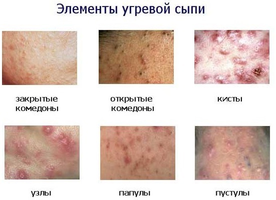 Acne on the back in women and men. Causes of appearance, how to treat, quickly remove at home