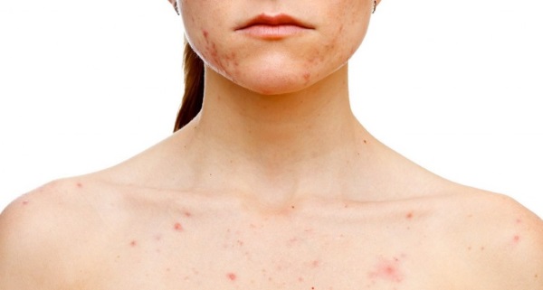 Acne on a woman's shoulders, chest, back, décolleté. Reasons for how to treat at home