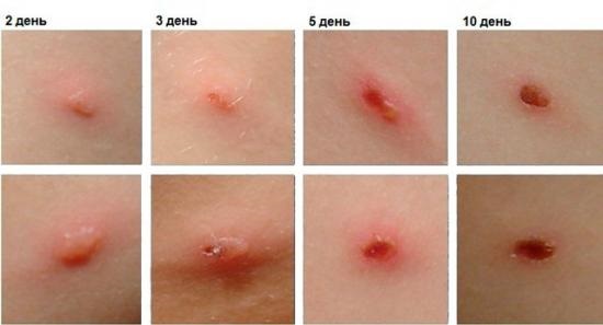 Acne on a woman's shoulders, chest, back, décolleté. Reasons for how to treat at home