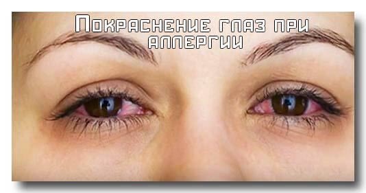 Dark bags under the eyes, circles around the eyes. Causes and treatment in women and men