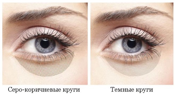 Dark bags under the eyes, circles around the eyes. Causes and treatment in women and men