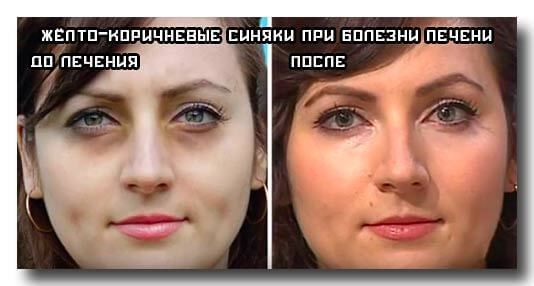 Dark bags under the eyes, circles around the eyes. Causes and treatment in women and men