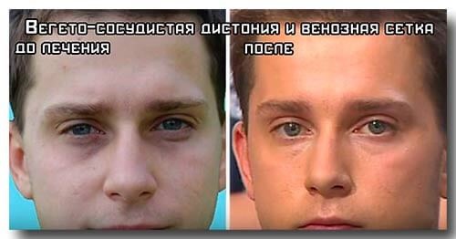 Dark bags under the eyes, circles around the eyes. Causes and treatment in women and men