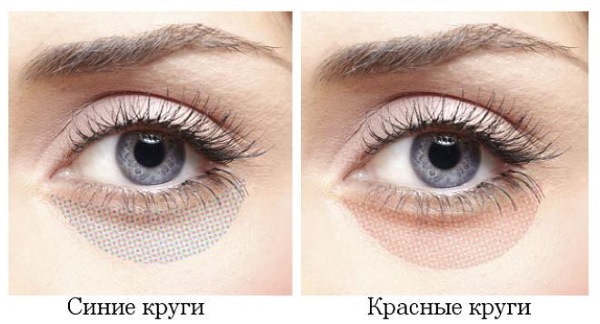 Dark bags under the eyes, circles around the eyes. Causes and treatment in women and men