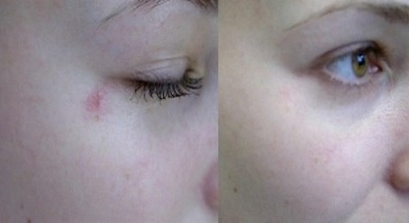 Removal of spider veins on the face with a laser. Contraindications, consequences. Prices, reviews