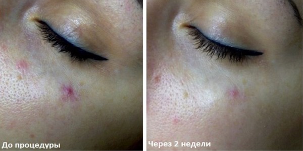 Removal of spider veins on the face with a laser. Contraindications, consequences. Prices, reviews