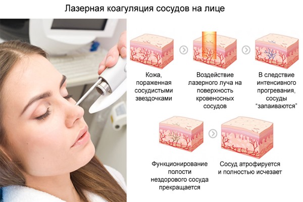 Rimozione delle vene dei ragni sul viso con un laser. Controindicazioni, conseguenze. Prezzi, recensioni