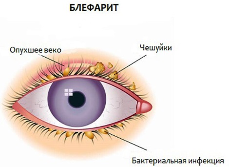 Blefarogel 2. Instructions for use, how to apply for barley, for face, eyelids, eyelash growth, for swelling under the eyes.Analogs