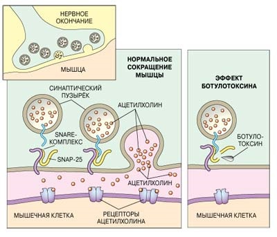 Botulinum therapy in cosmetology - what is it, effectiveness and results, reviews. Dysport, Xeomin, Botox