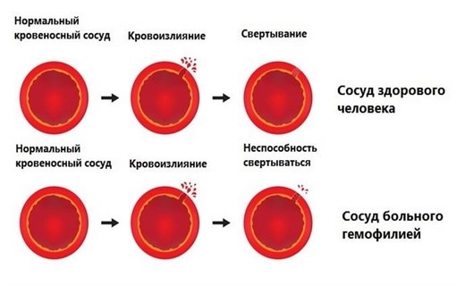 Botulinum therapy in cosmetology - what is it, effectiveness and results, reviews. Dysport, Xeomin, Botox