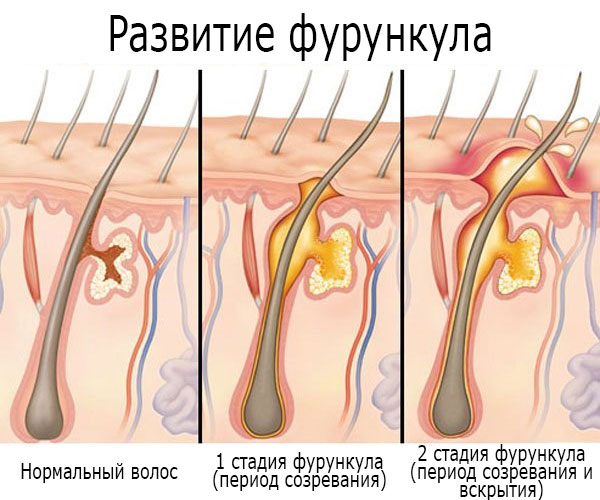 Darsonvalization - what is it in cosmetology, the benefits of the procedure for the skin of the face, head, eyelids, hair, devices. Indications and contraindications, effectiveness