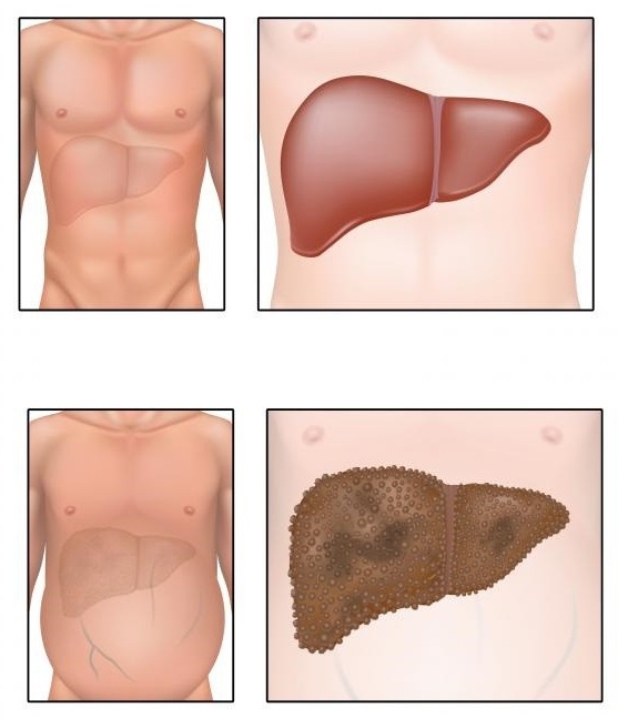 How to take Furosemide pills for weight loss. Instructions for use, indications, action